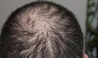 Solusi Masalah Kebotakan di Turki, Kini Transplantasi Rambut Sudah Ada di Indonesia