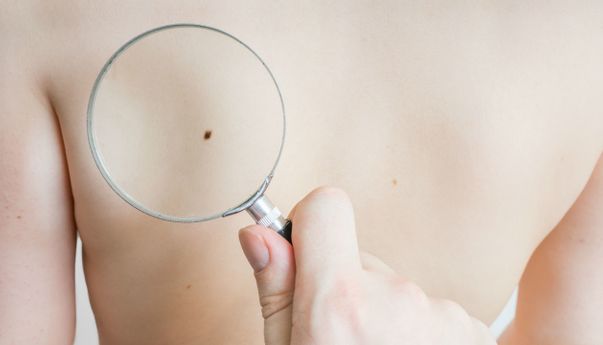 5 Arti Tahi Lalat Berdasarkan Letaknya