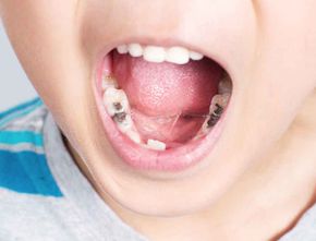 Bunda, Inilah Penyebab Gigi Berlubang pada Anak