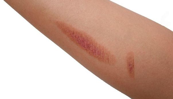 5 Cara Menghilangkan Bekas Luka di Tubuh dengan Bahan Alami
