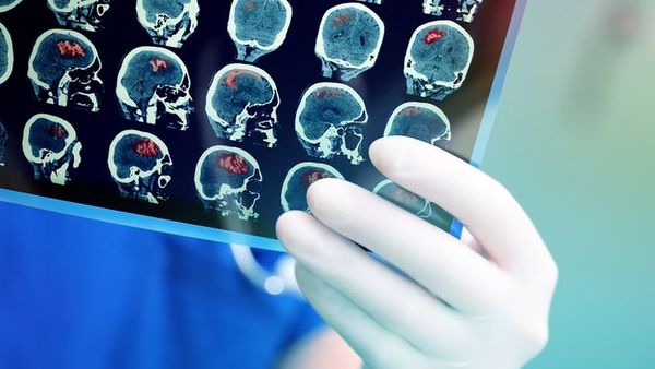 Kenali Lebih Jauh Soal Tumor Otak, Begini Rangkuman dari Para Ahli