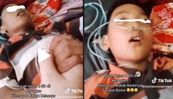 Viral! Bocah SD Alami Koma Setelah Dikeroyok Kakak Kelas, Kini Harus Pakai Selang Oksigen