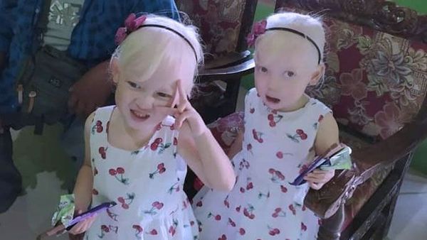 Berita Jateng: Anak Kembar Albino di Wonogiri Viral di Medsos, Orang Tua Dikira Pembantu