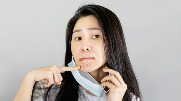 Apa Itu Maskne? Intip Penyebab dan Cara Mengatasinya