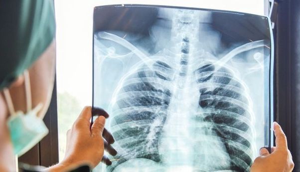 Berita Terbaru: Tracing Penderita TBC di Yogyakarta Terganggu Wabah Corona