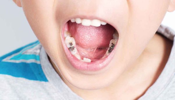 Bunda, Inilah yang Perlu Dilakukan Saat Gigi Anak Berlubang