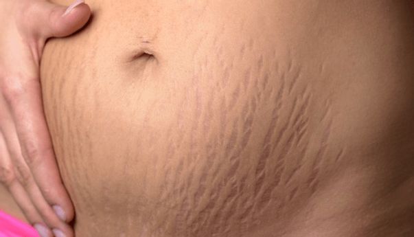Menyibak Manfaat Minyak Almond untuk Kulit, Salah Satunya Hilangkan Stretch Mark