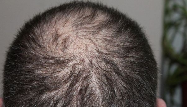 Solusi Masalah Kebotakan di Turki, Kini Transplantasi Rambut Sudah Ada di Indonesia
