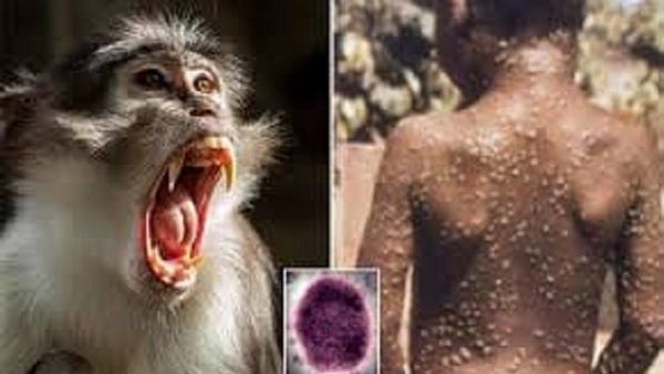 Peneliti Sebut Virus Cacar Monyet Sudah Menyebar Sejak 2017, Begini Penjelasannya
