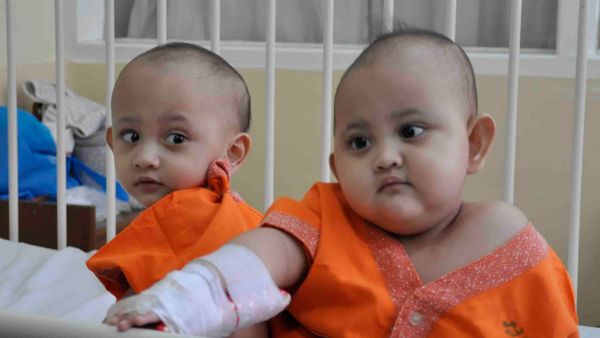 Operasi Pemisahan Bayi Kembar Pygopagus Naifa-Nayyara Butuh Waktu 25 Jam