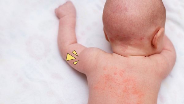 Ada Masalah Dengan Biang Keringat Bayi? Ini Cara Mengatasinya
