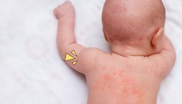 Ada Masalah Dengan Biang Keringat Bayi? Ini Cara Mengatasinya