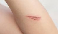 Terungkap! Cara Ampuh Hilangkan Bekas Luka di Kulit
