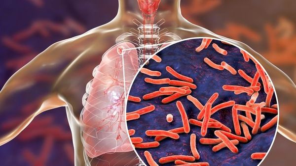 Berita Jateng: Kasus TBC di Pati Tinggi, Peringkat 23 di Jawa Tengah
