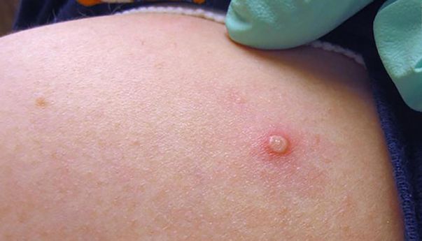 Sudah Mulai Menyerang Indonesia, Terkena Virus Cacar Monyet Bisa Disembuhkan?