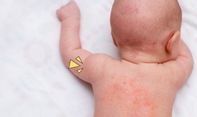 Ada Masalah Dengan Biang Keringat Bayi? Ini Cara Mengatasinya