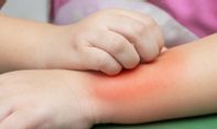 Beberapa Macam Obat Alergi Dingin yang Bagus untuk Penyembuhan