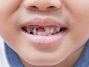 Mengenal Dampak Buruk Gigi Anak Berlubang pada Kesehatan