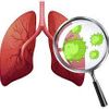 Cara Mudah Membersihkan Paru-paru dari Dahak yang Berlebih