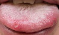 Mengobati Sariawan di Lidah, Begini Caranya!