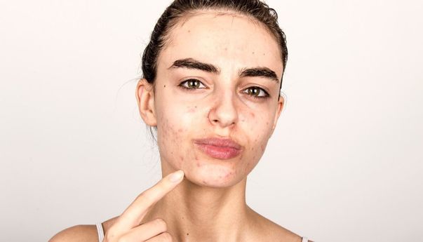 Ini Dia Ciri-Ciri Wajah Sedang Detoks yang Sebenarnya Justru Baik Untuk Kulit