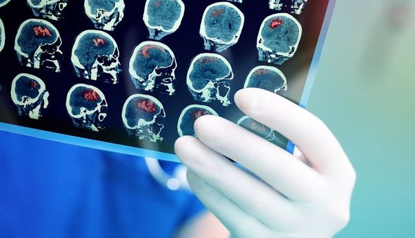 Kenali Lebih Jauh Soal Tumor Otak, Begini Rangkuman dari Para Ahli