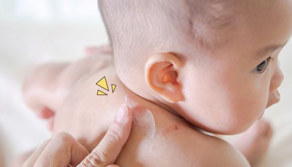 Nyamuk Lebih Suka Gigit Bayi Daripada Orang Dewasa, Kenapa?