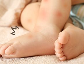 Ibu Wajib Tahu! Cara Atasi Bentol dan Gatal Akibat Gigitan Nyamuk Pada Bayi