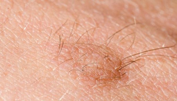 Perlukah Merisaukan Rambut Tahi Lalat yang Tiba-tiba Muncul, Gejala Kanker Kulit?