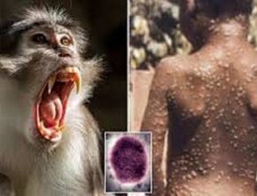 Peneliti Sebut Virus Cacar Monyet Sudah Menyebar Sejak 2017, Begini Penjelasannya