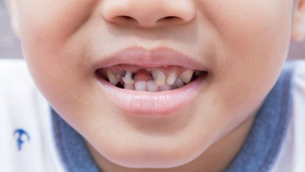 Mengenal Dampak Buruk Gigi Anak Berlubang pada Kesehatan