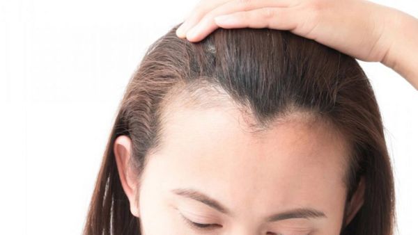 Ini Cara Mengatasi Kebotakan Rambut yang Terjadi di Usia Muda