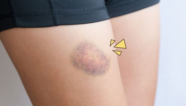 Pakai Bahan Alami dan Aman: Begini Cara Hilangkan Cedera Memar, Ada 7 Cara!