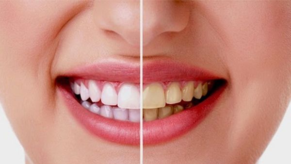 Cara Memutihkan Gigi dengan Bahan Alami, Dijamin Aman