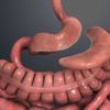 Sleeve Gastrectomy: Operasi Bariatrik Buang 80 Persen Lambung
