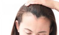 Ini Cara Mengatasi Kebotakan Rambut yang Terjadi di Usia Muda