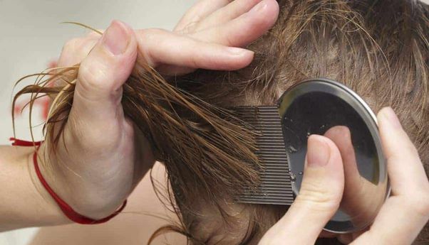Ini Cara Menghilangkan Kutu Rambut Beserta Telurnya
