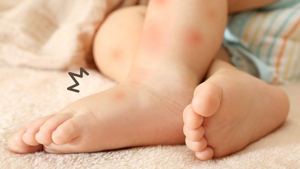 Ibu Wajib Tahu! Cara Atasi Bentol dan Gatal Akibat Gigitan Nyamuk Pada Bayi