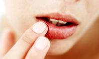 Bibir Kering pada Ibu Hamil, Begini Cara Mengatasinya!