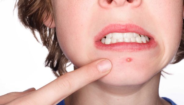 Ladies, Inilah Cara Aman Menghilangkan Jerawat Batu Pada Wajah