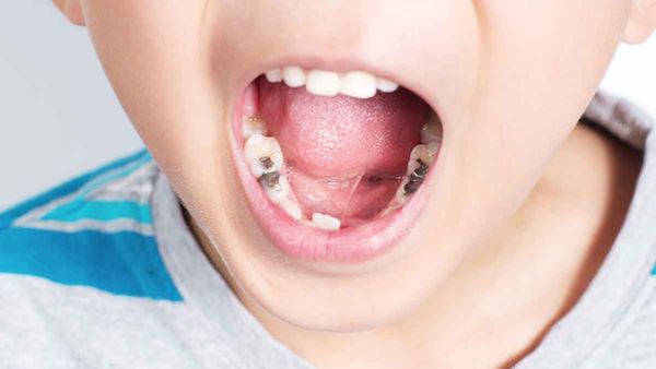 Bunda, Inilah yang Perlu Dilakukan Saat Gigi Anak Berlubang