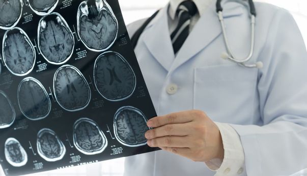 Waspada! Inilah Gejala Awal Pecah Pembuluh Darah di Otak