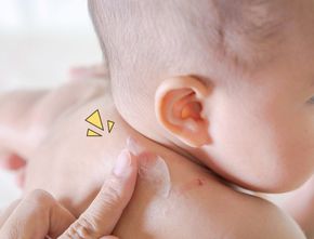 Mom, Ini Cara Atasi Kulit Bayi yang Hitam Karena Gigitan Nyamuk