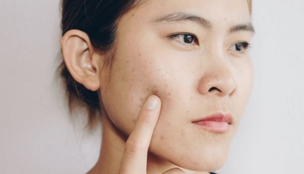 Kerap Bikin Nggak Pede, Apa itu Jerawat Pasir?