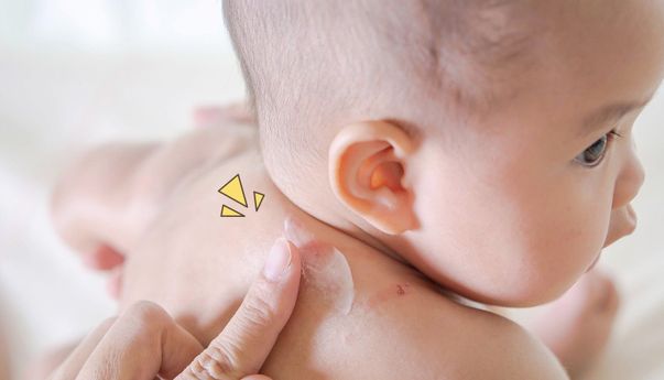 Mom, Ini Cara Atasi Kulit Bayi yang Hitam Karena Gigitan Nyamuk