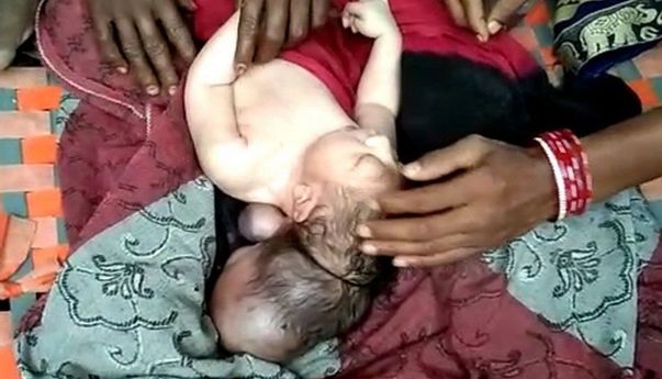 Kelahiran Bayi Berkepala Tiga Bikin Heboh, Dianggap Jelmaan Dewa oleh Warga India