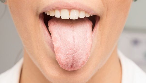 Perlu Diwaspadai Ini Dia Penyebab Lidah Putih Pada Orang Dewasa