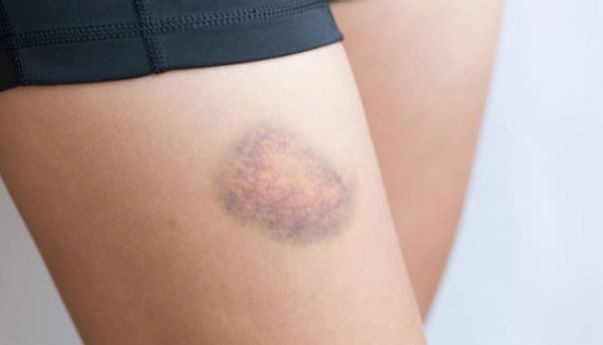 Tanda Diabetes yang Muncul pada Kulit, Waspada!