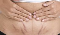 Bikin Perut Cantik Kembali, Ini Tips Hilangkan Stretch Mark Secara Alami