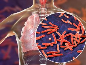 Berita Jateng: Kasus TBC di Pati Tinggi, Peringkat 23 di Jawa Tengah